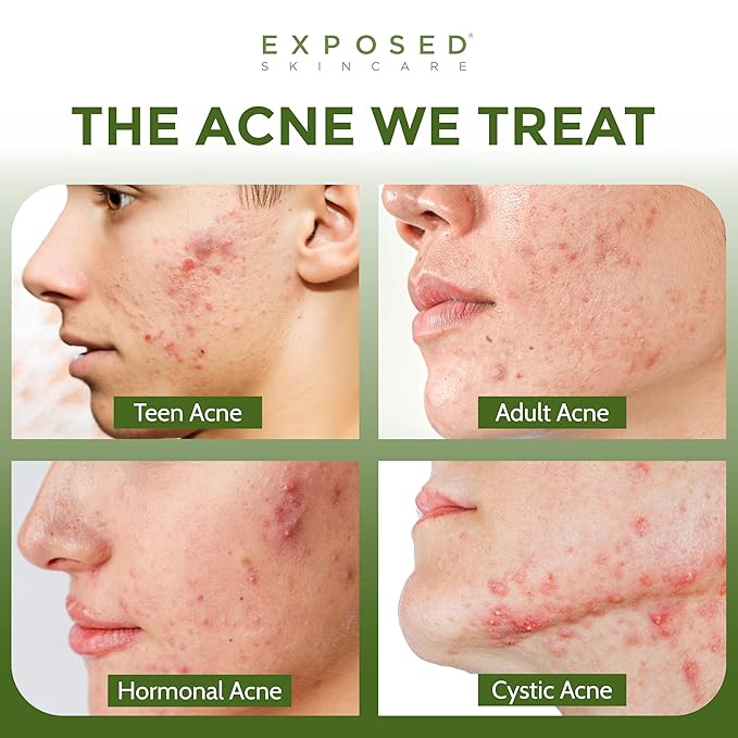 Exposed Skin Care, Clear Pore Serum with 1% Salicylic Acid for Sensitive and Oily Skin – Gently Clears Blackheads, Minimizes Pores and Reduces Excess Oil – Natural, Non-toxic and Cruelty Free